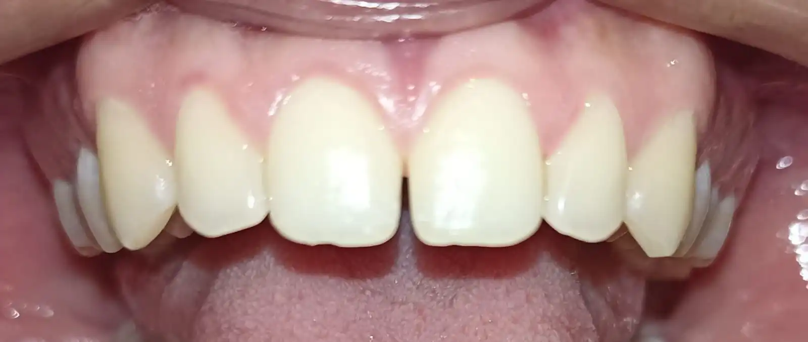 Antes del diseño de sonrisa